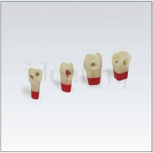 ANA4ZSDPK 302 V1 N&ordm;27 diente esmalte-dentina-pulpa c/caries