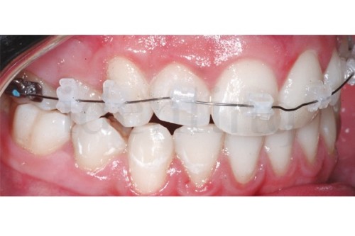 BRACKETS ROTH 018 KIT 5-5 SUP. E INF.