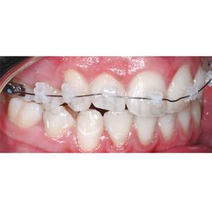 BRACKETS AQUA LEONE ROTH 018 REPOSICION