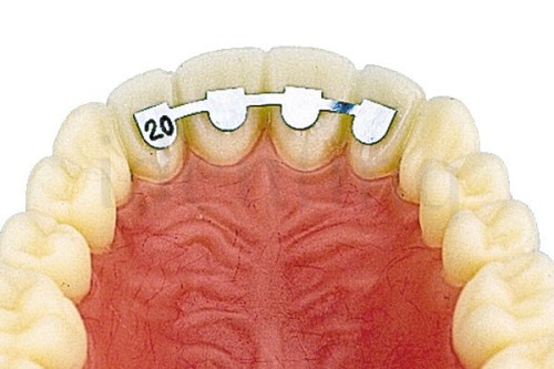 RETENEDORES LINGUALES LATERAL A LATERAL SUPERIOR