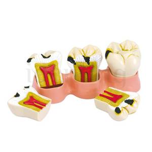 MODELO ESTADOS DE LA CARIES