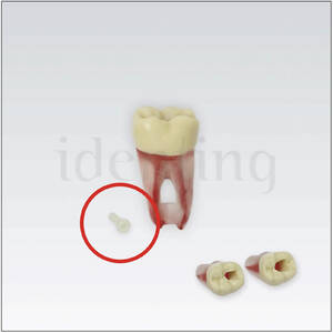 0326 FRASACO tornilllo pl&aacute;stico p/dientes de endo