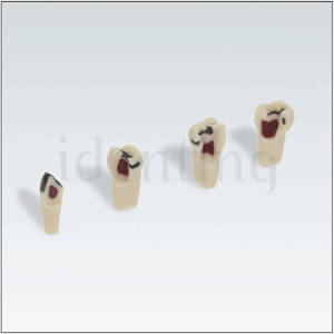 AK62ZPUWPK N&ordm;55 pulpa rellena c/cera y caries 1 ud